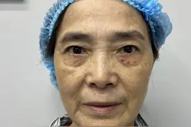 63岁终于把眼袋手术做了，没有开刀，术后即刻长这样，钱花的值图片