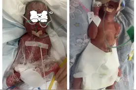 900g超早产宝宝与江西省人民医院的81天图片