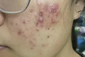 超值性价比！低成本摆平痤疮痘印！一分冤枉钱不多花！图片