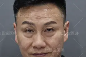 年近50岁，把眼袋和泪沟一起做了，6天恢复，闺女说：不认识了图片