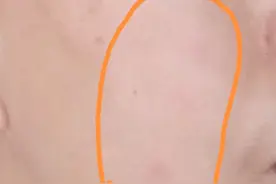 乳腺肿瘤的我 今天脸上长了几个小红疙瘩，不知是啥，夏天要注意些图片