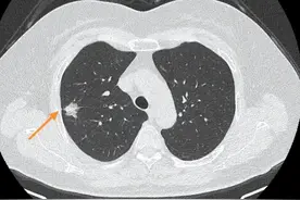 CT报告上出现这些字眼，通常是肺结节的恶性特征，要足够重视！图片