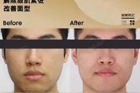 全牙列反颌（地包天），掩饰性正畸做到咬合最好。图片
