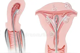 子宫息肉一定要切除吗？这里有最全的解答！图片