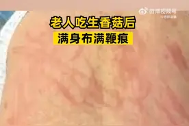 老人吃生香菇后满身布满鞭痕，医生：由香菇诱导的鞭状红斑图片