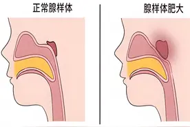 腺样体肥大，不手术，也能缩小的好方法，可以保存！图片