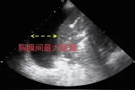 胸腔积液的超声诊断及定量测量图片