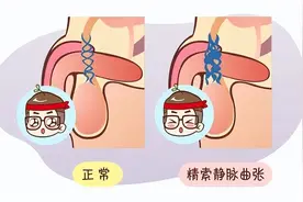 中国男性健康日|精索静脉曲张，你了解吗？图片