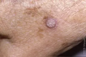 脖子上长这种小肉粒，可能感染了HPV！不要掉以轻心！图片