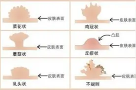 女方检查发现HPV感染，男方会有什么表现？需要检查治疗吗？图片