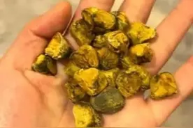 29岁女生体内取24颗胆结石，没事盘着玩，网友:最有味道的盘物!图片