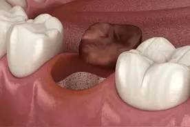 拔完牙后嘴里一股屎臭，告诉医生后，他比我还慌！他在怕什么？图片