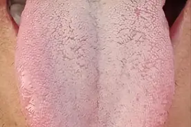 看到舌根是黄腻苔，就盲目清热，大错特错，关键在于补阳和调脾！图片