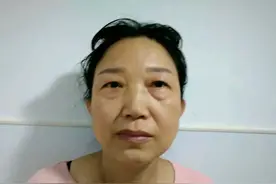 56岁做完眼袋手术57天，术后恢复过程大公开，术后说出真实感受图片