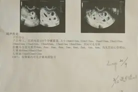 25岁女子怀上九胞胎？！专家分析来了图片