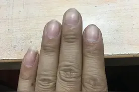 体内有癌，手指知道？提醒：手部若有3个异样，或是肿瘤侵袭了图片