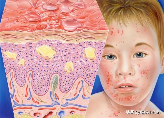 幼儿急疹：家长必看的护理注意事项与用药科普
