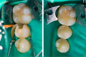 补牙后牙疼到怀疑人生，有可能是这4个原因导致的图片