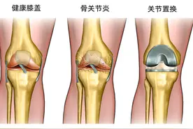 膝关节置换手术后，什么时候最难熬，该注意些什么？图片