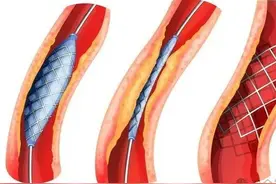 心梗后！该含硝酸甘油？还是速效救心丸？图片