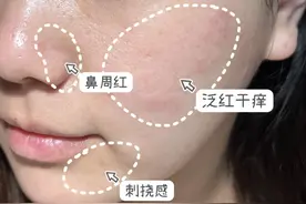 公认好用的5款“敏感肌”好物：理肤泉烂脸救急，春娟价格良心图片