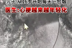 男子16岁起每天1包烟32岁重度心梗图片