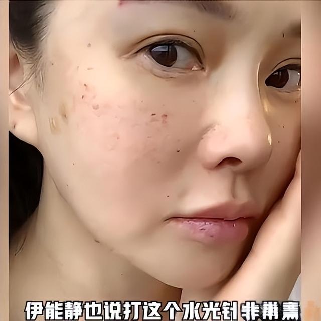 伊能静好真实，大胆展示自己脸上针孔，为了变美也是不容易啊