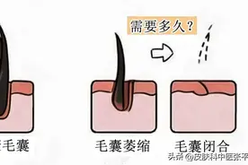 脱发——被低估的毛囊再生方法图片
