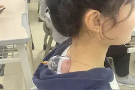 帅气老师给学生拔罐？“头发变多”的秘笈来了图片