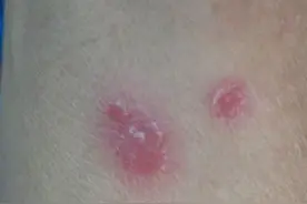 牛皮癣的详细治疗方法，你治对了吗？图片