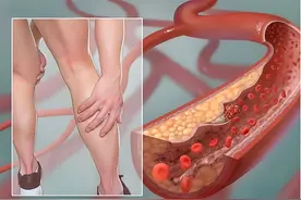 不论男女，脚上出现3种变化，可能是“糖尿病来找你了，勿大意”图片