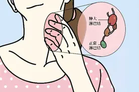 颈部淋巴结肿大别慌，它不一定是啥大事儿图片