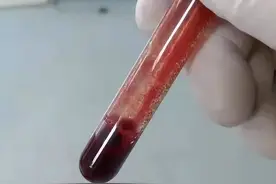 天冷了，明明穿很厚，手指和脚趾却苍白疼痛，怎么回事？图片