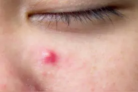 囊肿结节型痘痘怎么治疗？看完这篇你就懂了图片