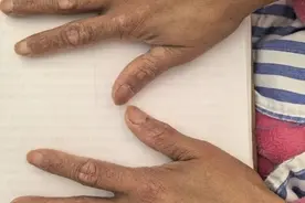 吃了三年牛黄解毒片，35岁女子查出“砒霜”中毒！医生惊呆：肠子都黑了图片