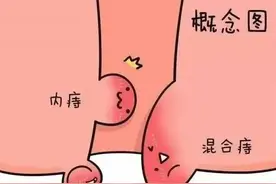 痔疮外痔肉球如何消除?？？图片