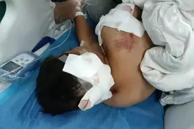 犬伤人再次发生！10岁男童被阿拉斯加犬咬伤，事发第四天才从ICU转至普通病房……图片