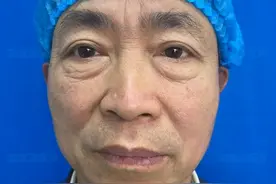 60岁不顾家人阻拦，用退休金去做眼袋，术后即刻脸成了这样！图片