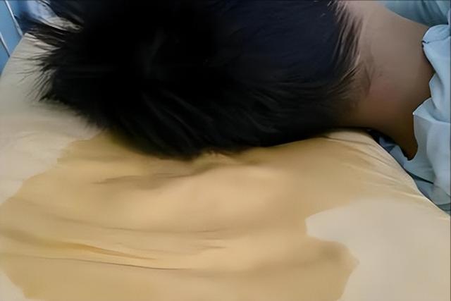 不是皮肤病	，而是癌症预警？皮肤出现4种情况，建议早做检查