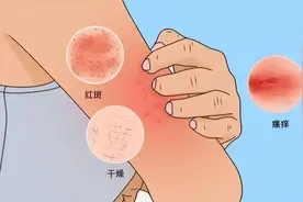 一个中成药，止痒有奇效，化解皮肤病，远离湿疹、荨麻疹、皮炎！图片