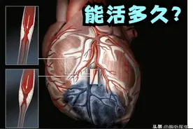 什么是心脏搭桥手术？做了手术能活多久？需要注意什么？图片