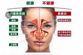 鼻窦炎到底要不要做手术呢？你关心的都在这里！图片