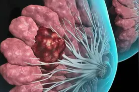 乳腺癌患者，5点需注意，别让这些细节成为乳腺癌复发的导火索图片