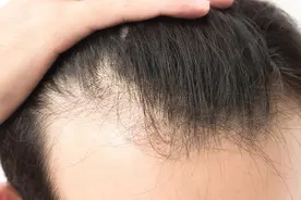 为什么脱发会集中在特定部位？不同位置的脱发原因解析图片