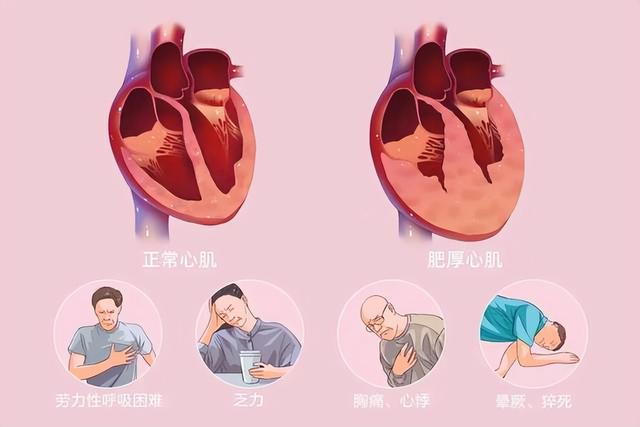 我国心肌病患者超300万，出现这些症状别不当回事，及时筛查