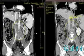 男子确诊癌症晚期，生存期预计1年！准备放弃时，医生一个决定让他逆天改命图片