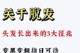 脱发—头发长出来的3大征兆，变黑变粗指日可待图片