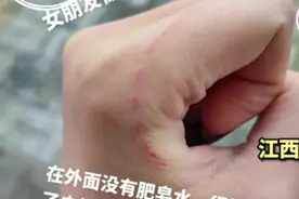江西南昌：一男生用嘴帮女友吸伤口 确诊“三级暴露”图片