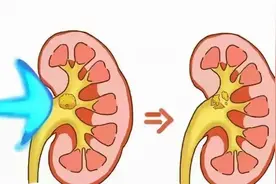 成都打结石医院：碎石能否反复碎？关于体外碎石那点事你知多少图片