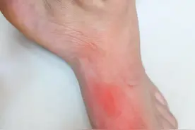 男子脚面疼痛以为是扭伤，没想到是糖尿病发展到病变，早知早好图片